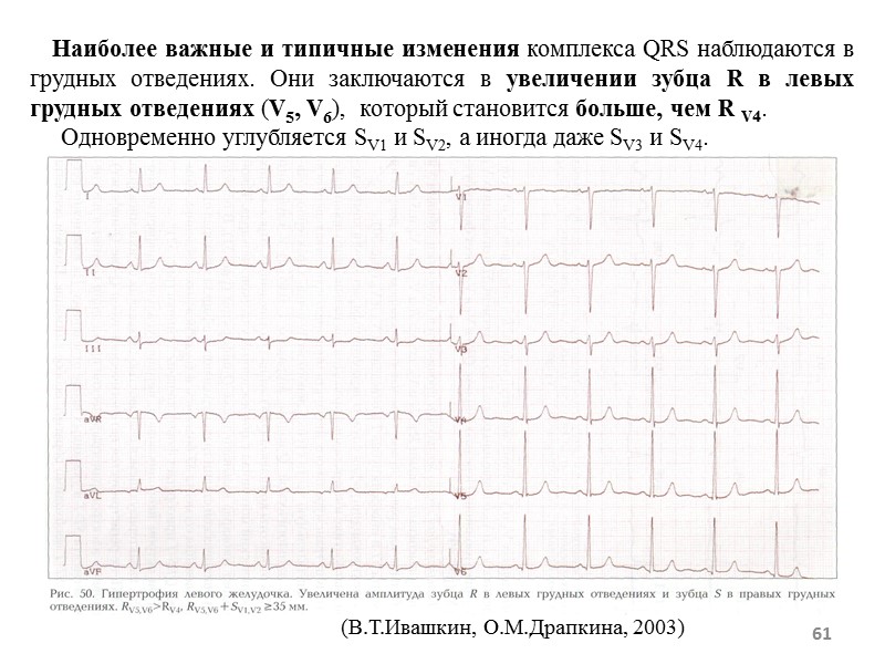 61 Наиболее важные и типичные изменения комплекса QRS наблюдаются 61 Наиболее важные и типичные изменения комплекса QRS наблюдаются
